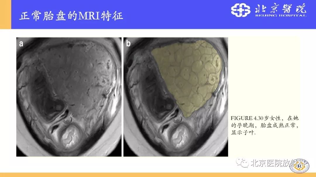 【PPT】胎盘从正常变异到植入异常与恶性肿瘤的MRI评估