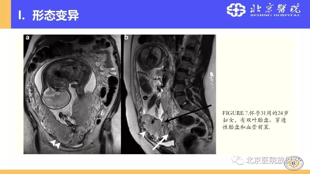【PPT】胎盘从正常变异到植入异常与恶性肿瘤的MRI评估