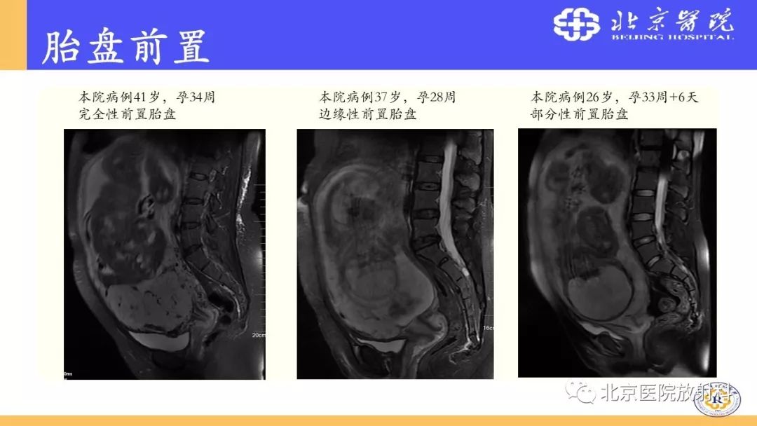 【PPT】胎盘从正常变异到植入异常与恶性肿瘤的MRI评估