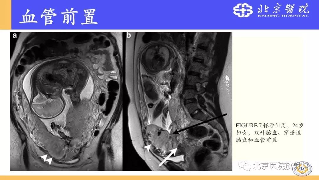 【PPT】胎盘从正常变异到植入异常与恶性肿瘤的MRI评估