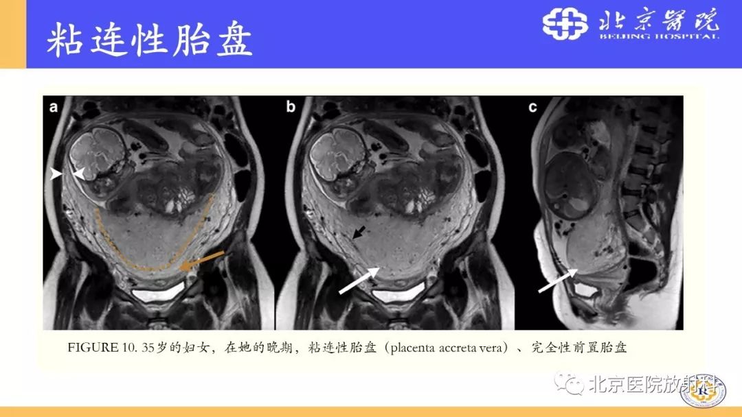 【PPT】胎盘从正常变异到植入异常与恶性肿瘤的MRI评估