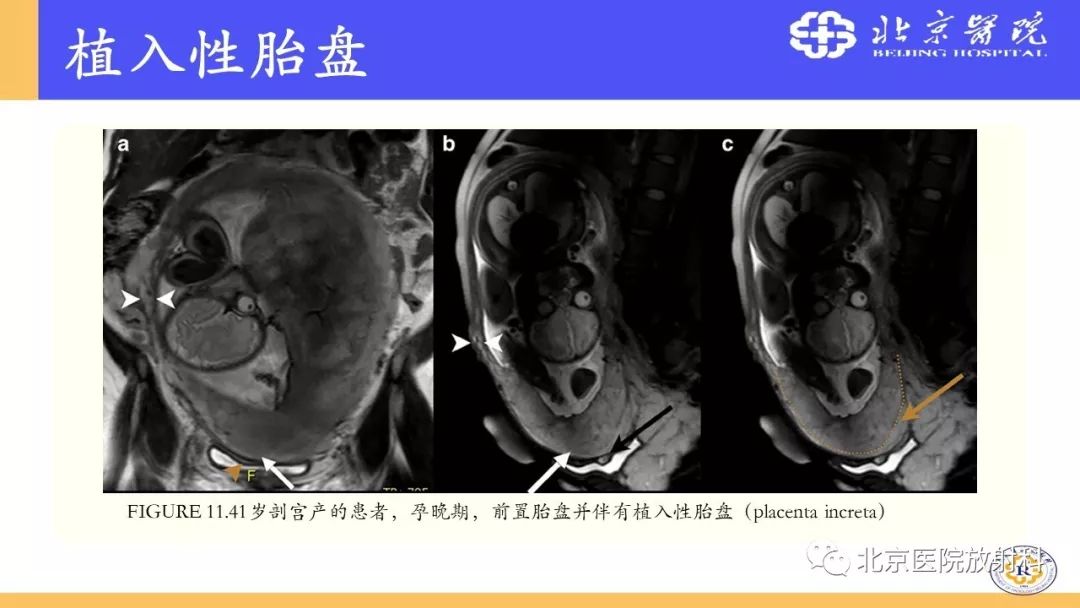 【PPT】胎盘从正常变异到植入异常与恶性肿瘤的MRI评估