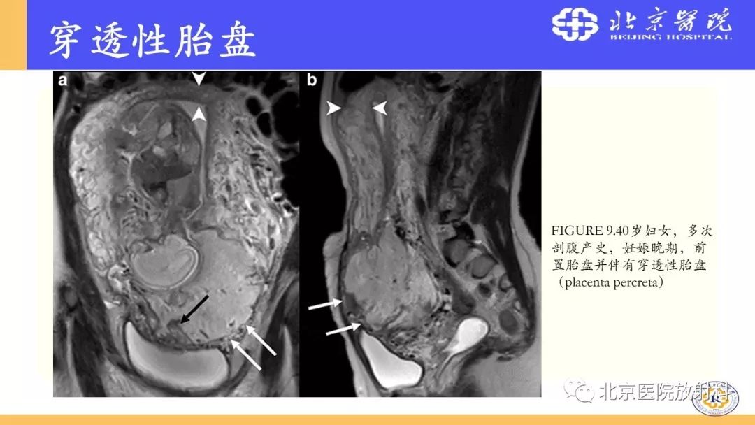 【PPT】胎盘从正常变异到植入异常与恶性肿瘤的MRI评估