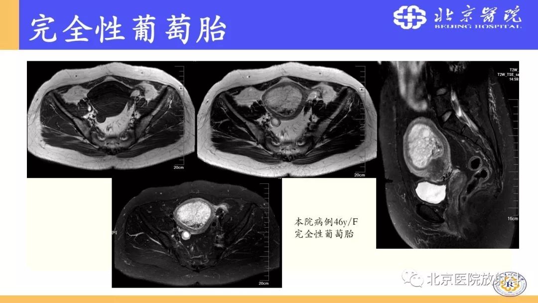 【PPT】胎盘从正常变异到植入异常与恶性肿瘤的MRI评估