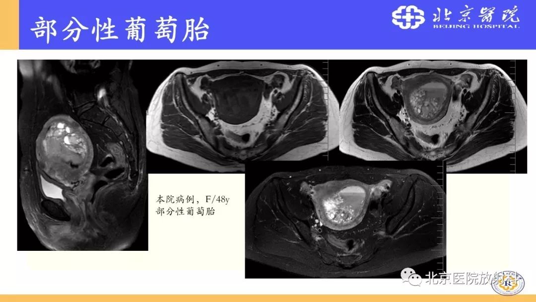 【PPT】胎盘从正常变异到植入异常与恶性肿瘤的MRI评估