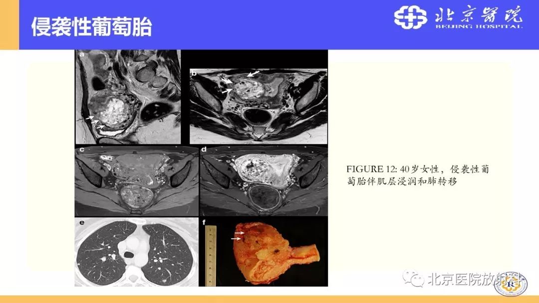 【PPT】胎盘从正常变异到植入异常与恶性肿瘤的MRI评估