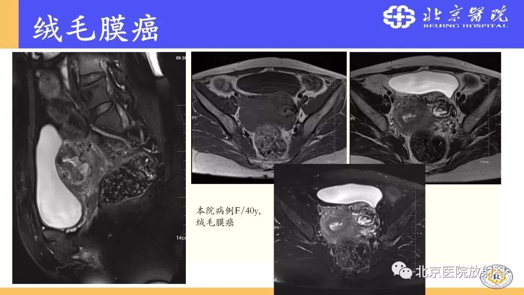 【PPT】胎盘从正常变异到植入异常与恶性肿瘤的MRI评估