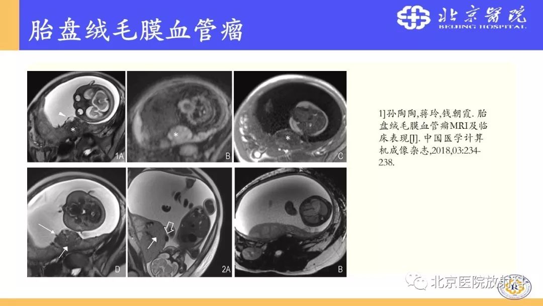 【PPT】胎盘从正常变异到植入异常与恶性肿瘤的MRI评估