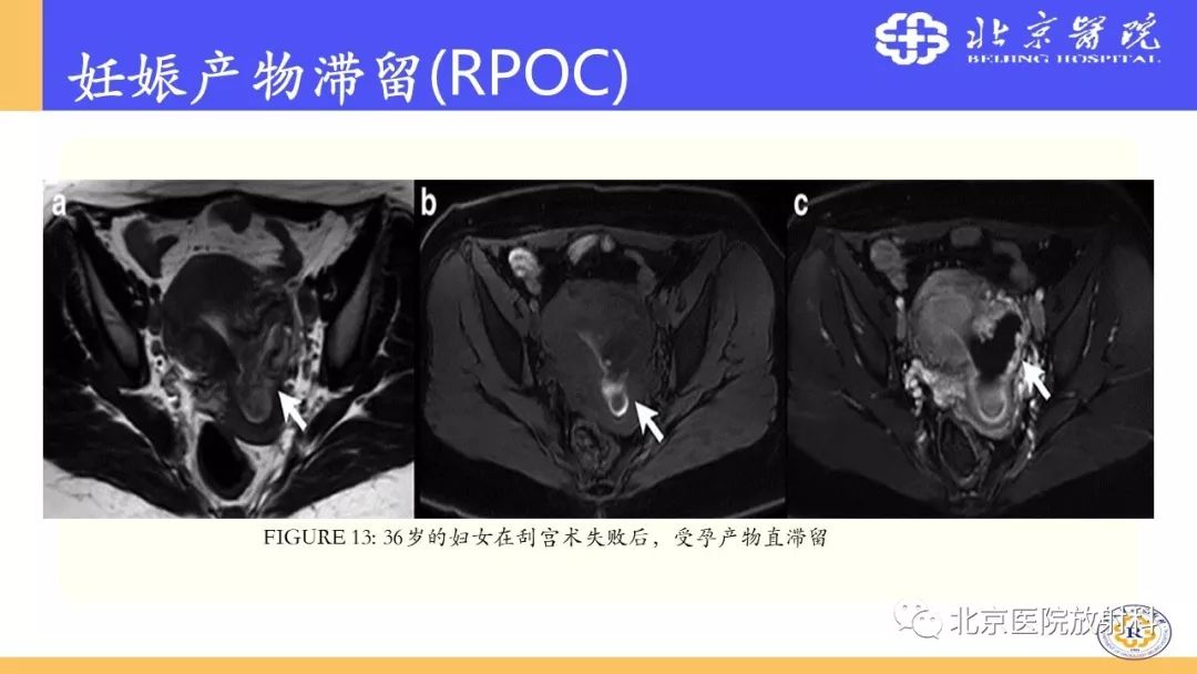 【PPT】胎盘从正常变异到植入异常与恶性肿瘤的MRI评估