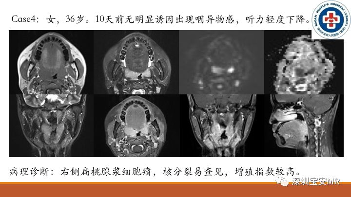 【病例】扁桃体淋巴瘤2例MR影像