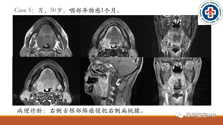 【病例】扁桃体淋巴瘤2例MR影像