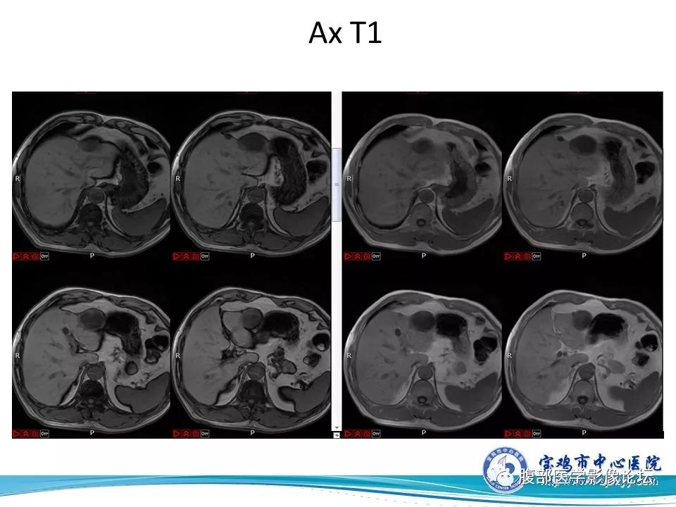 【病例】不典型肝血管瘤1例CT及MR影像