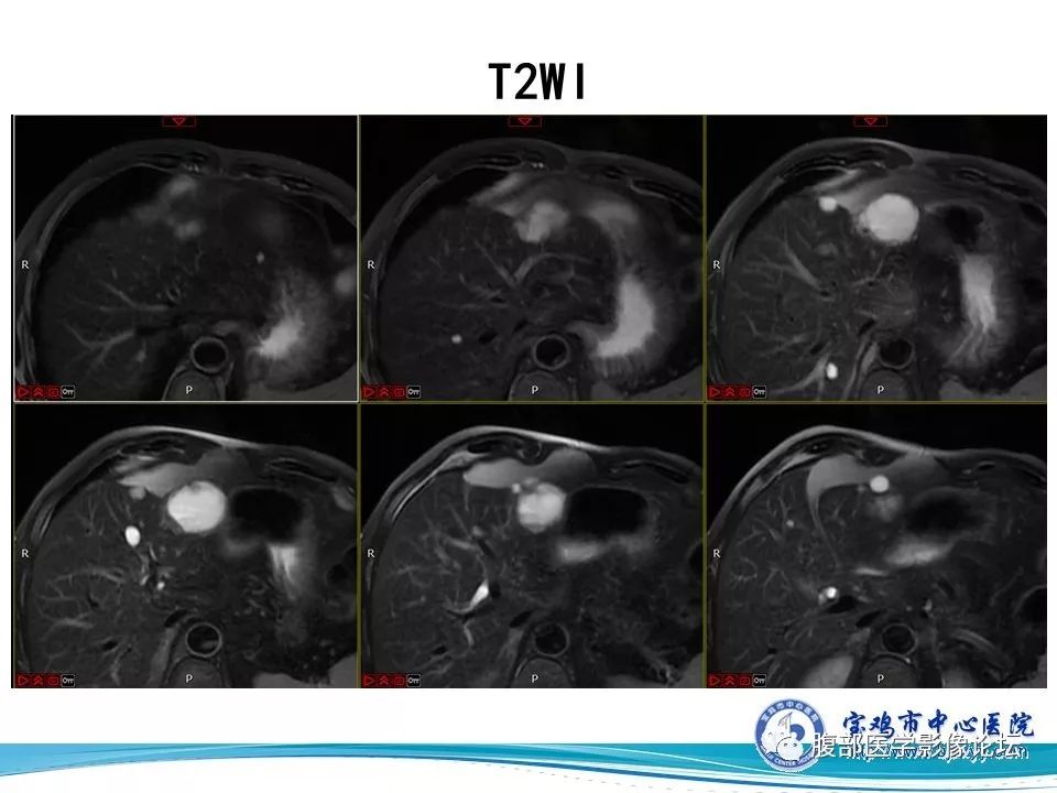 【病例】不典型肝血管瘤1例CT及MR影像