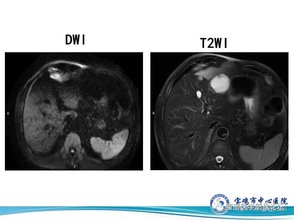 【病例】不典型肝血管瘤1例CT及MR影像