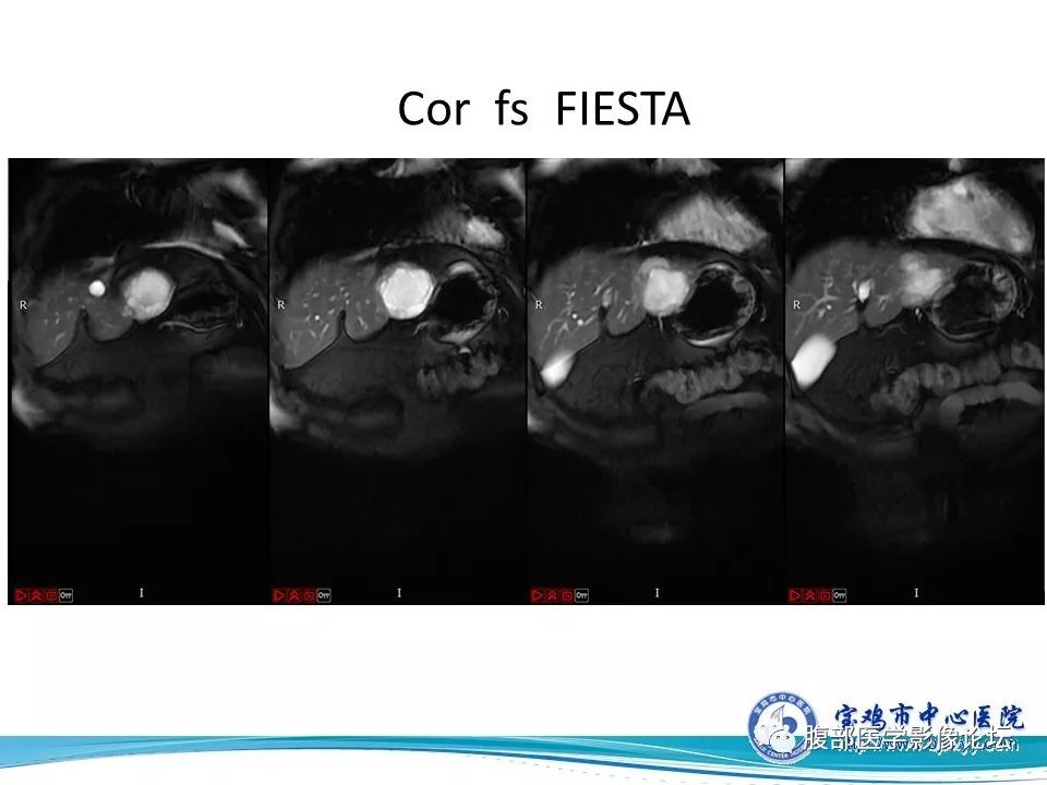【病例】不典型肝血管瘤1例CT及MR影像