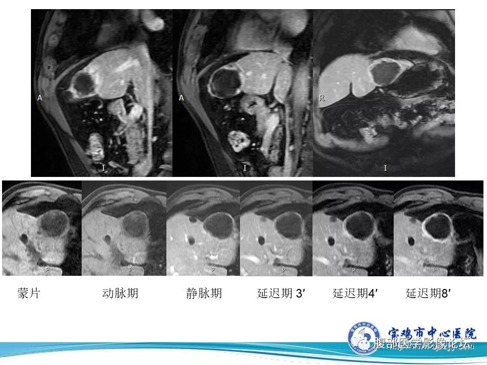 【病例】不典型肝血管瘤1例CT及MR影像