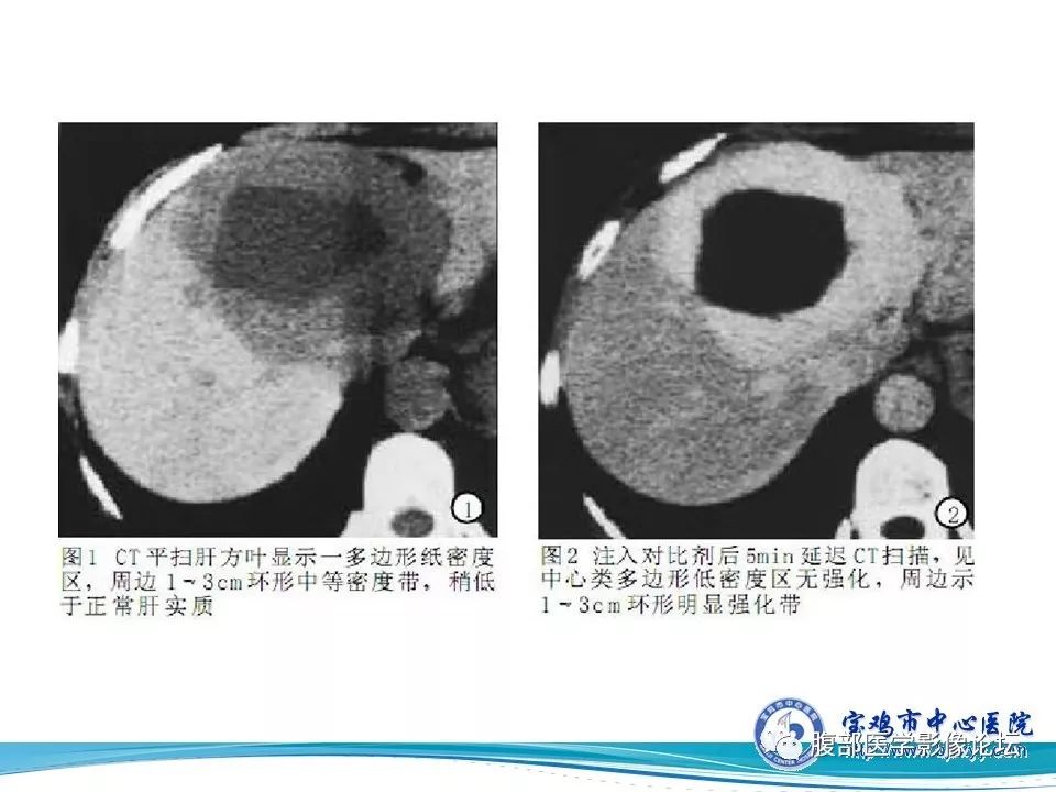 【病例】不典型肝血管瘤1例CT及MR影像