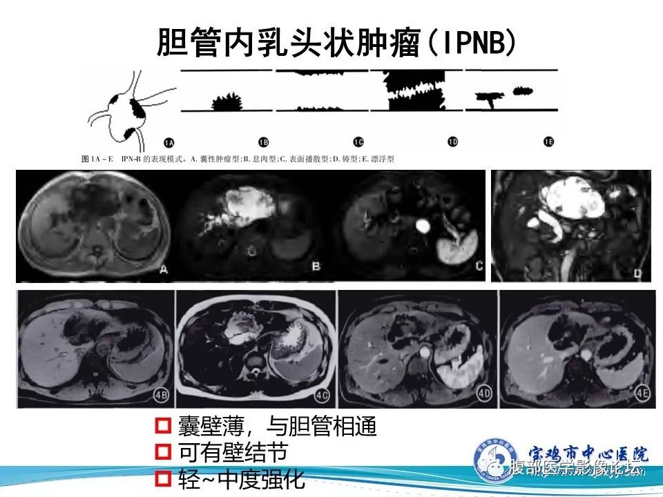 【病例】不典型肝血管瘤1例CT及MR影像