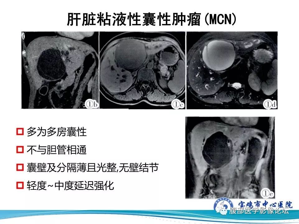 【病例】不典型肝血管瘤1例CT及MR影像