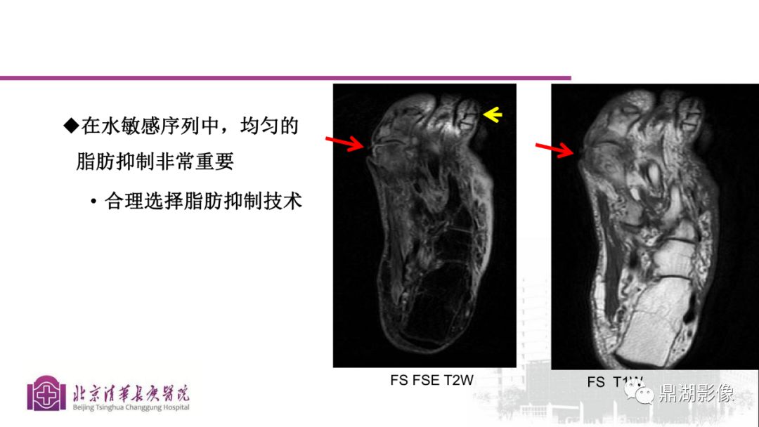 【PPT】四肢肌骨成像MRI扫描技术
