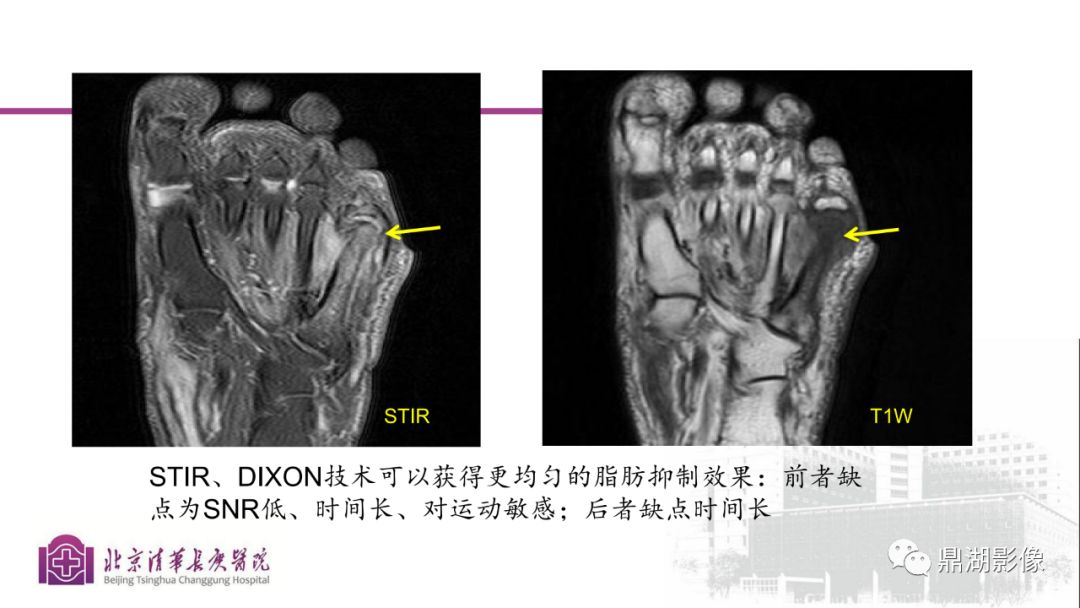【PPT】四肢肌骨成像MRI扫描技术