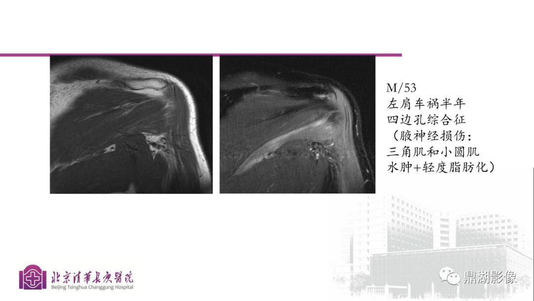 【PPT】四肢肌骨成像MRI扫描技术