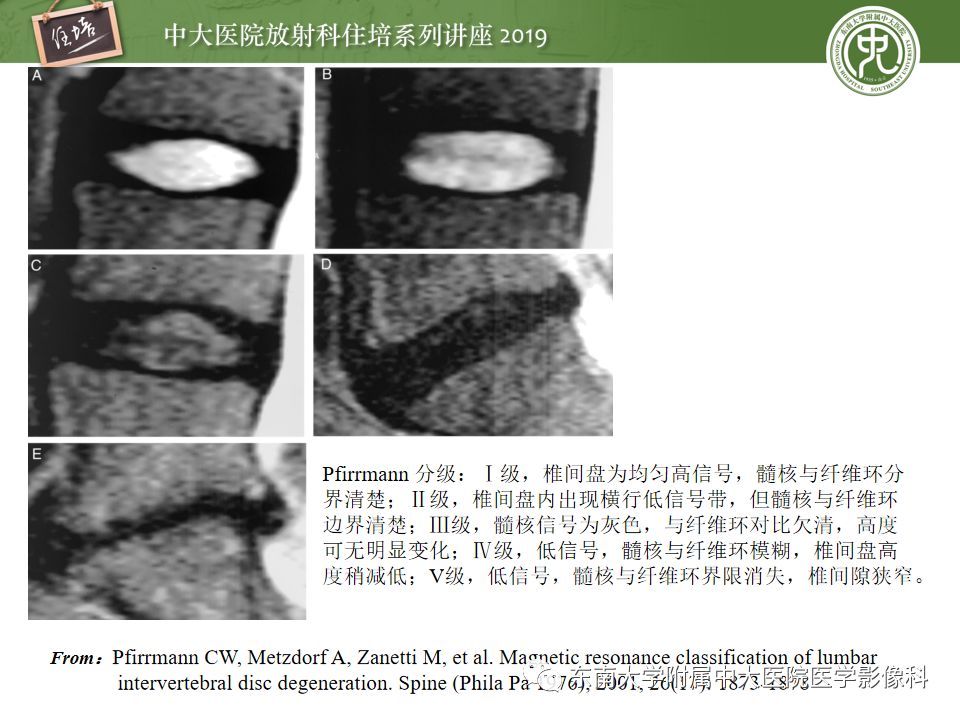 【PPT】椎间盘病变的影像分型及评价