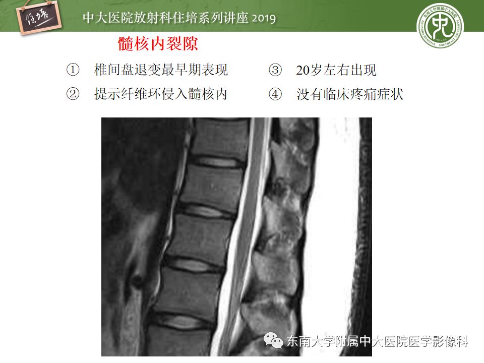 【PPT】椎间盘病变的影像分型及评价