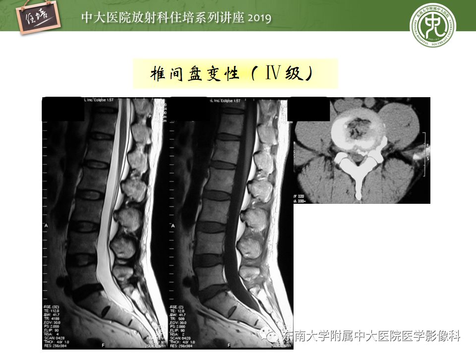 【PPT】椎间盘病变的影像分型及评价
