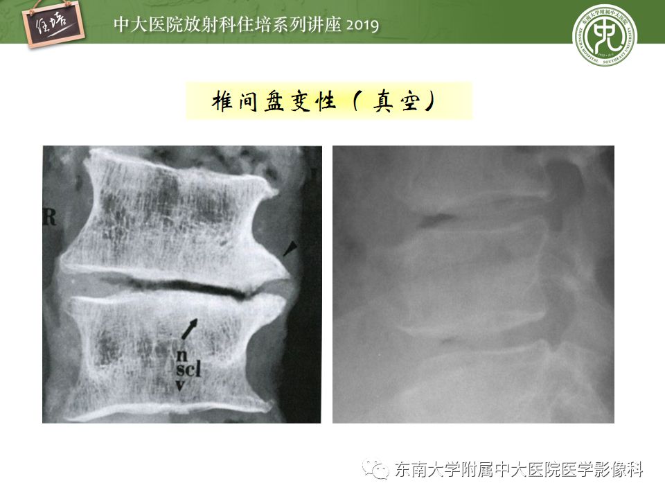 【PPT】椎间盘病变的影像分型及评价