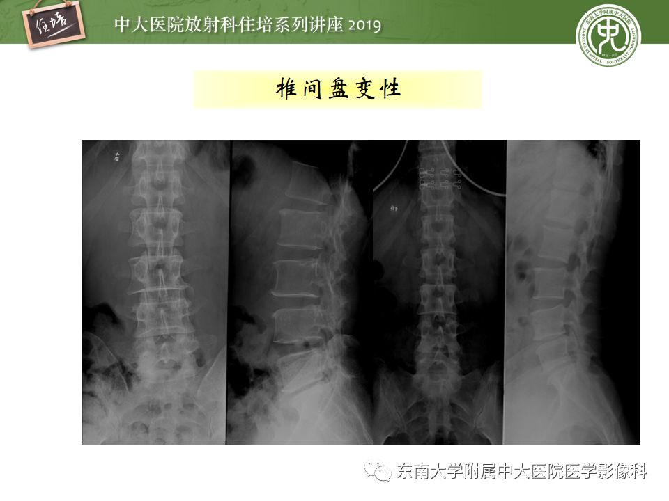 【PPT】椎间盘病变的影像分型及评价