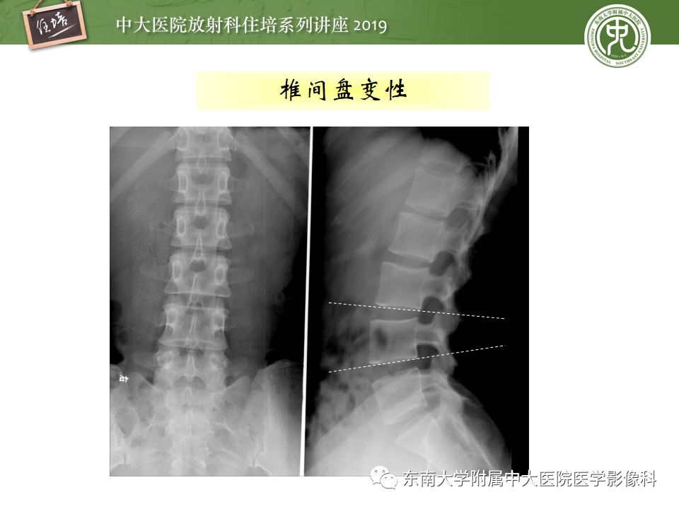 【PPT】椎间盘病变的影像分型及评价