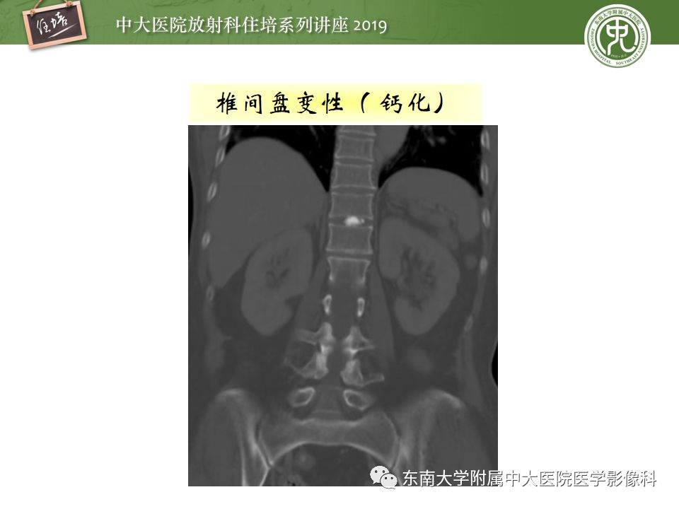 【PPT】椎间盘病变的影像分型及评价