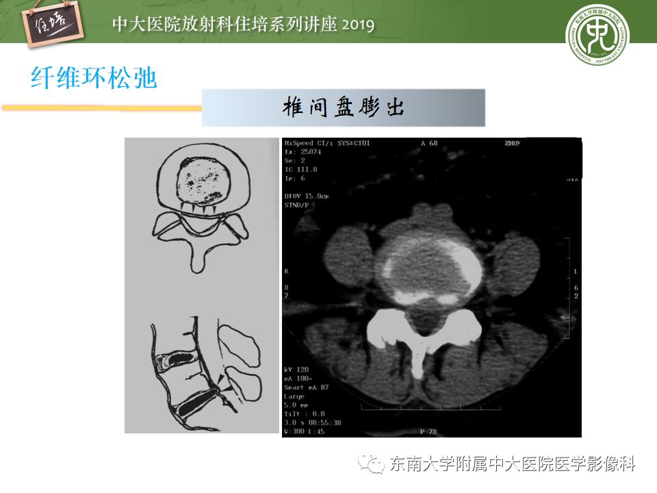 【PPT】椎间盘病变的影像分型及评价