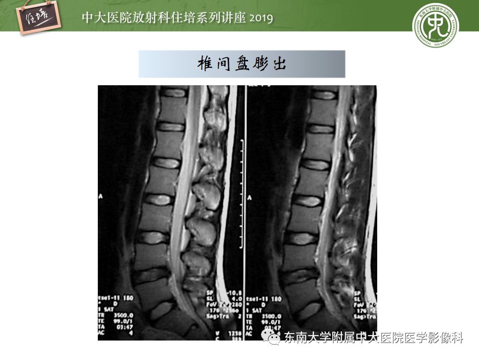 【PPT】椎间盘病变的影像分型及评价