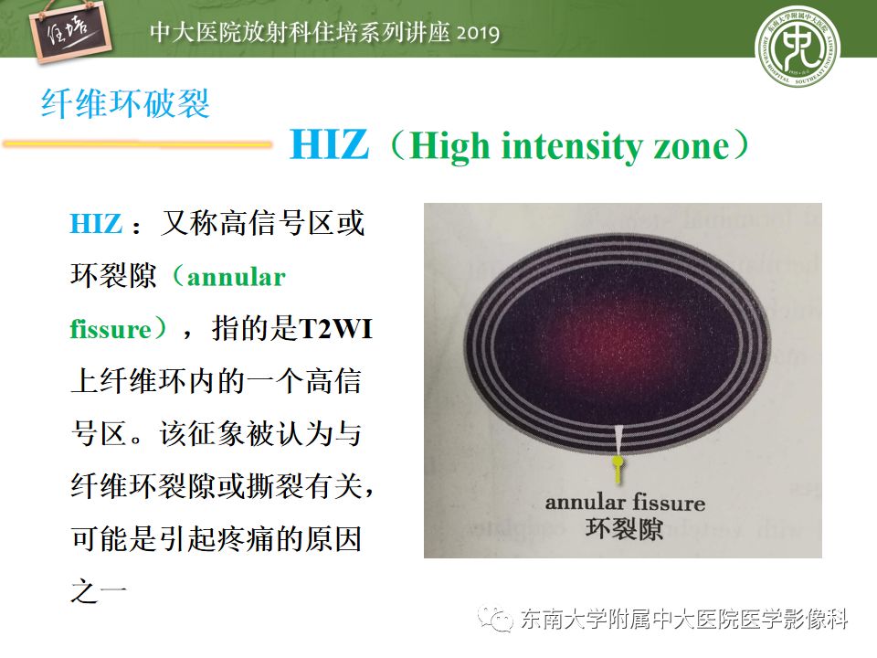 【PPT】椎间盘病变的影像分型及评价
