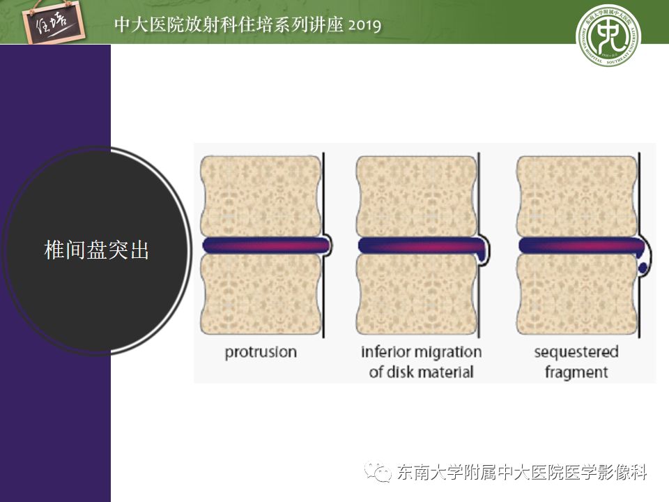【PPT】椎间盘病变的影像分型及评价