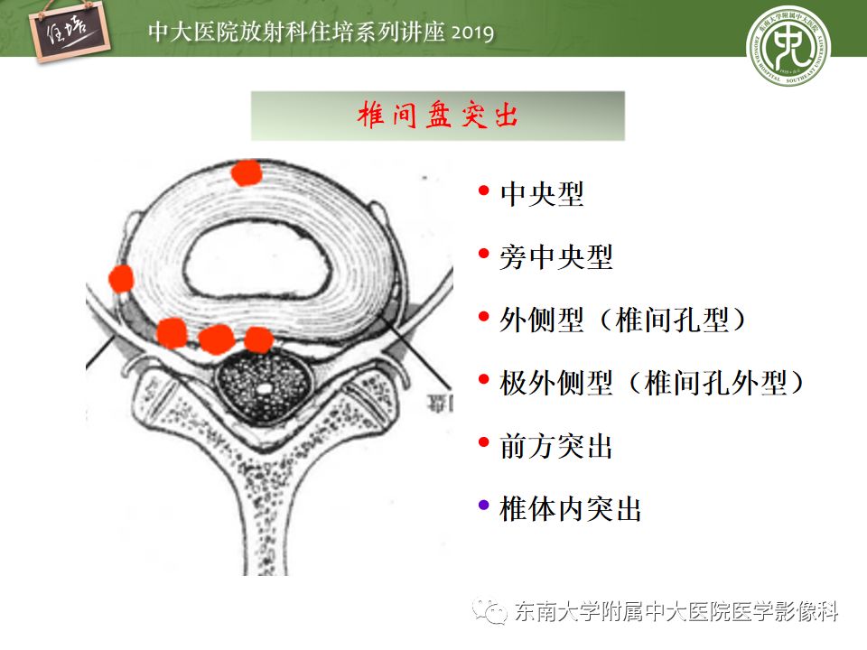 【PPT】椎间盘病变的影像分型及评价