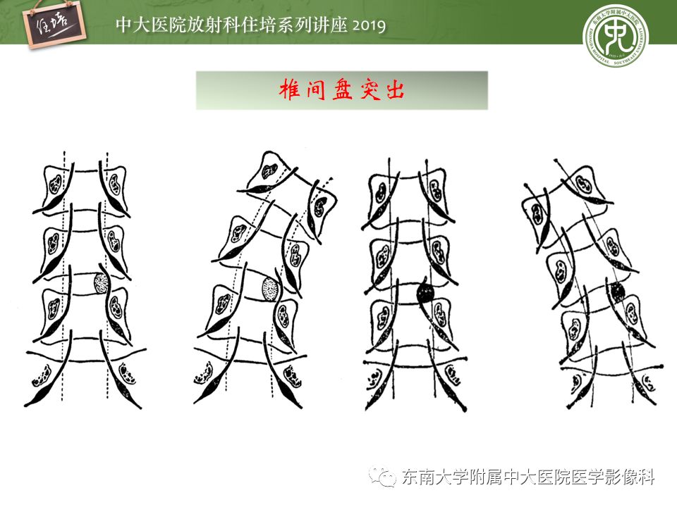 【PPT】椎间盘病变的影像分型及评价