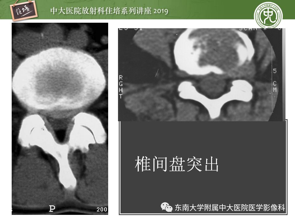 【PPT】椎间盘病变的影像分型及评价