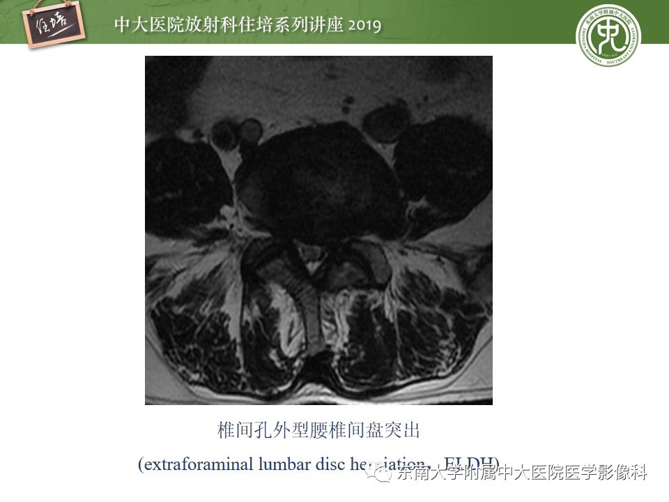【PPT】椎间盘病变的影像分型及评价