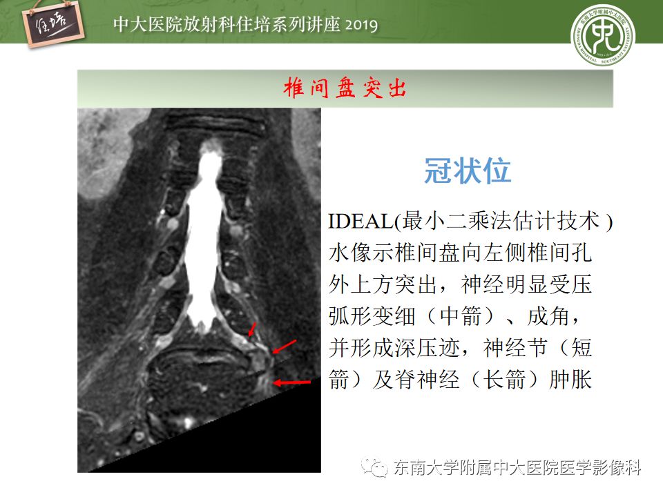 【PPT】椎间盘病变的影像分型及评价