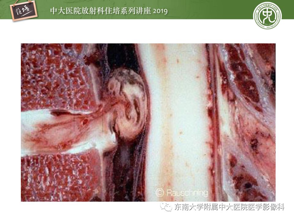 【PPT】椎间盘病变的影像分型及评价