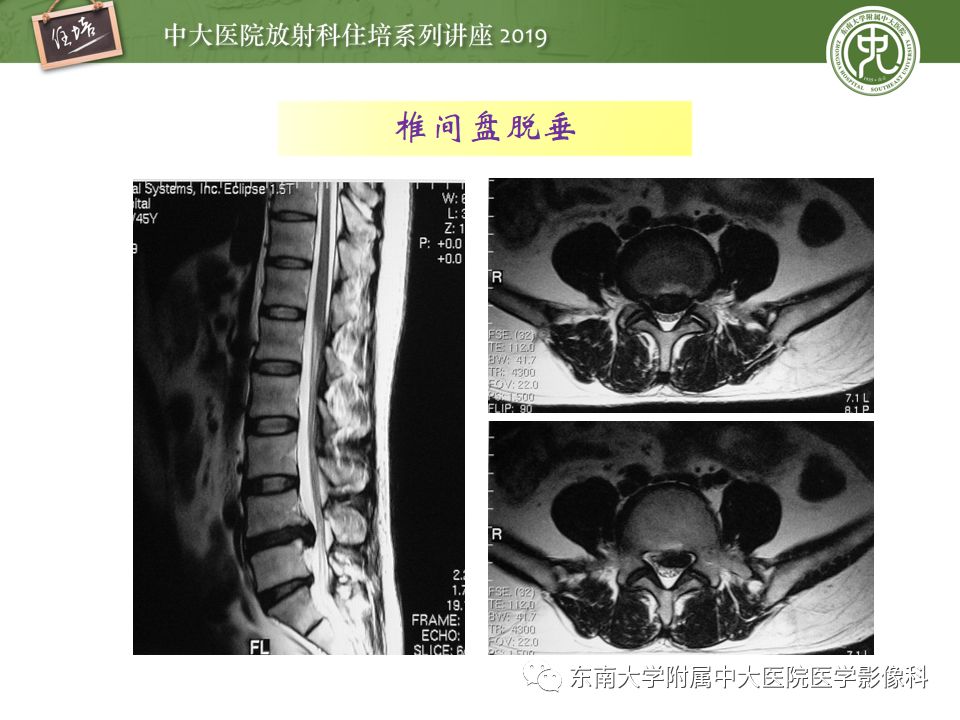 【PPT】椎间盘病变的影像分型及评价