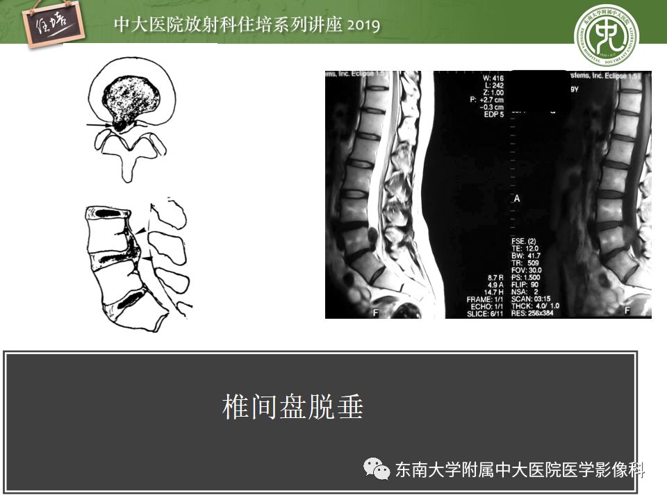 【PPT】椎间盘病变的影像分型及评价