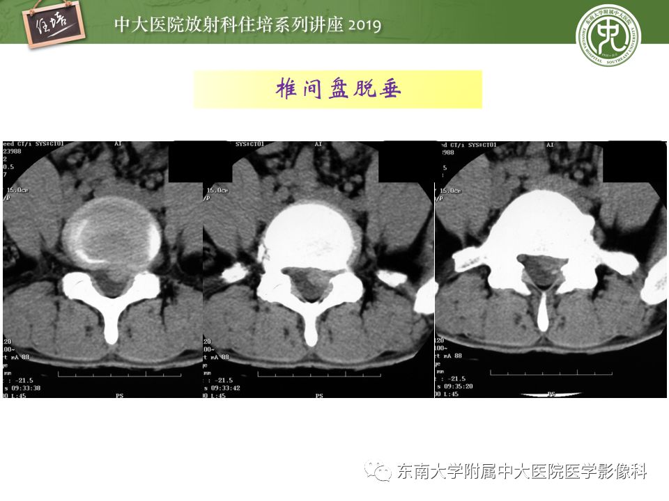 【PPT】椎间盘病变的影像分型及评价