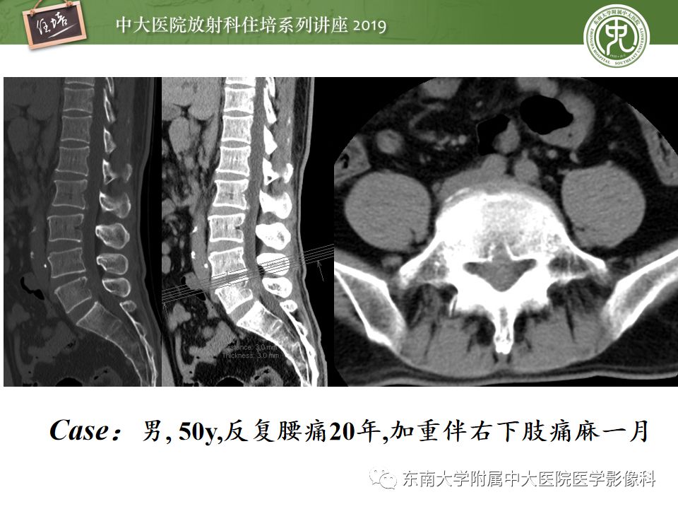 【PPT】椎间盘病变的影像分型及评价