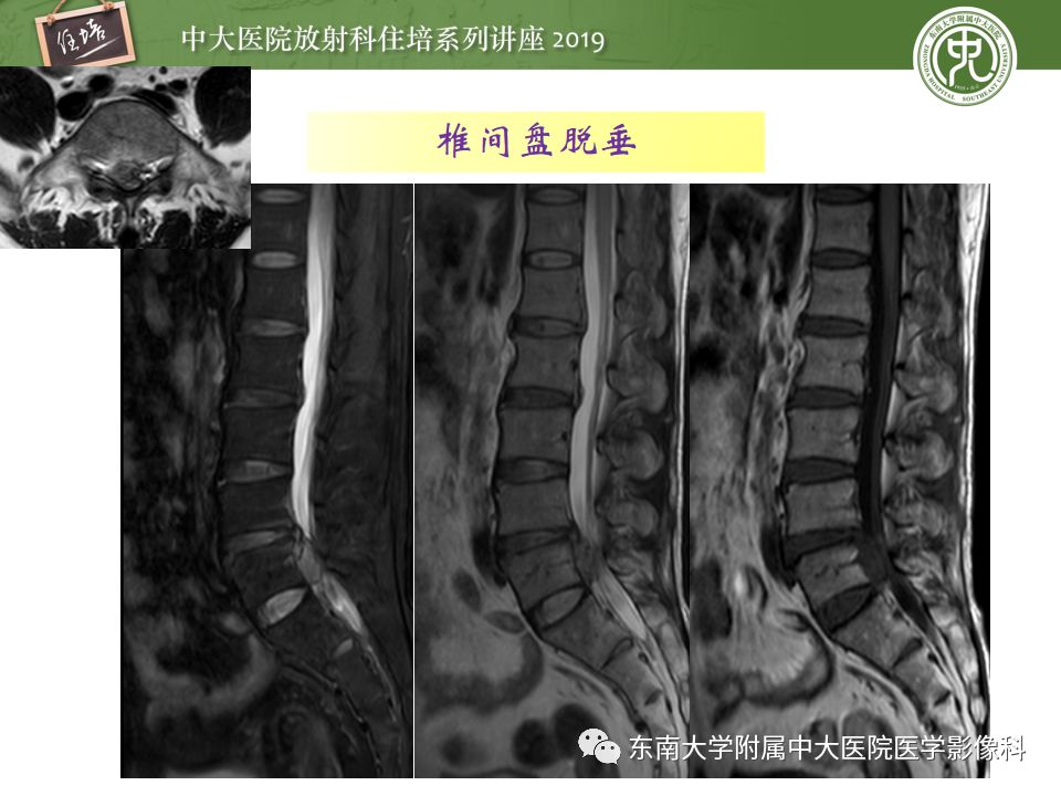 【PPT】椎间盘病变的影像分型及评价