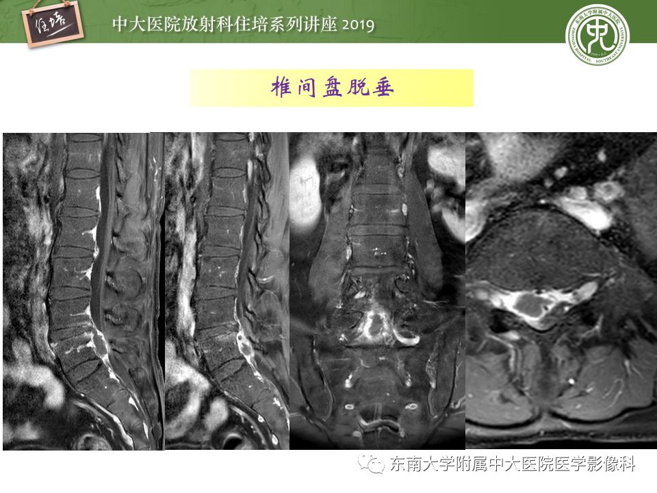【PPT】椎间盘病变的影像分型及评价
