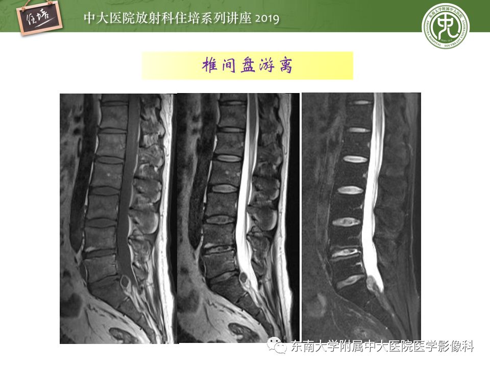 【PPT】椎间盘病变的影像分型及评价
